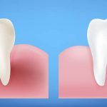 diente limpio vs diente sucio