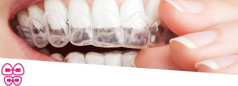 Invisalign | Clínica Dental Manosalbas