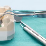 Beneficios implantes dentales | Clínica Dental Manosalbas