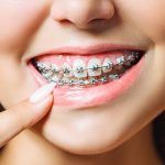 Fases de un tratamiento de ortodoncia