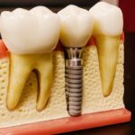 5 Consejos para una rápida recuperación tras un implante dental